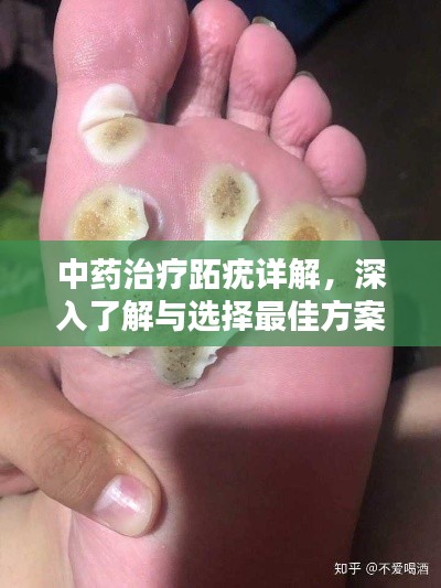 中药治疗跖疣详解，深入了解与选择最佳方案
